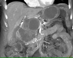 Cystadenoma - CTisus CT Scan