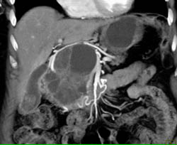 Cystadenoma - CTisus CT Scan