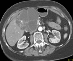 Cystadenoma - CTisus CT Scan