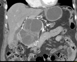 Cystadenoma - CTisus CT Scan