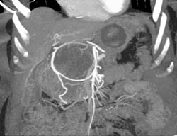 Cystadenoma - CTisus CT Scan