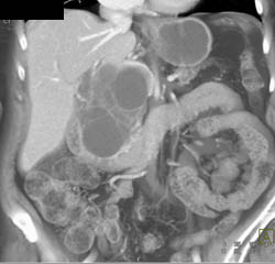 Cystadenoma - CTisus CT Scan