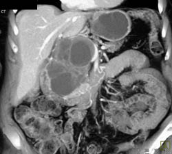 Cystadenoma - CTisus CT Scan