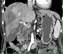 Liver Abscess and Infarction - CTisus CT Scan