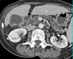 Dilated Pancreatic Duct With Ampullary Mass - CTisus CT Scan