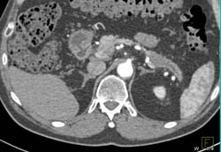 Mass in Tail of Pancreas With Dilated Pancreatic Duct - CTisus CT Scan