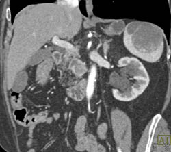 Islet Cell Tumor Head of Pancreas and Intraductal Papillary Mucinous Neoplasm (IPMN) in Tail of Pancreas - CTisus CT Scan