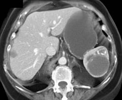 Intraductal Papillary Mucinous Neoplasm (IPMN) - CTisus CT Scan