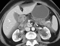 Intraductal Papillary Mucinous Neoplasm (IPMN) - CTisus CT Scan