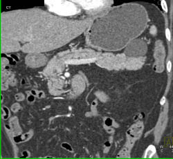 Intraductal Papillary Mucinous Neoplasm (IPMN) - CTisus CT Scan