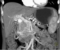 Pancreatic Cancer With PV/SMV Invasion and CTPY. See Portal Vein Thrombus - CTisus CT Scan