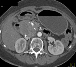 Islet Cell Tumor - CTisus CT Scan