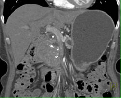 Islet Cell Tumor - CTisus CT Scan