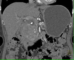 Islet Cell Tumor - CTisus CT Scan