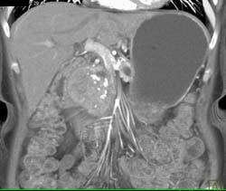 Islet Cell Tumor - CTisus CT Scan