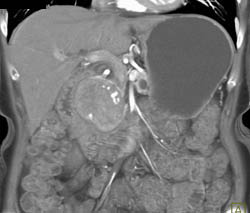 Islet Cell Tumor - CTisus CT Scan