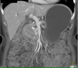 Islet Cell Tumor - CTisus CT Scan