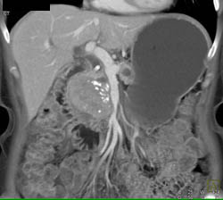 Islet Cell Tumor - CTisus CT Scan