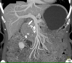 Islet Cell Tumor - CTisus CT Scan