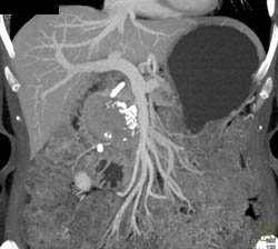 Islet Cell Tumor - CTisus CT Scan