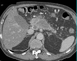 Adenocarcinoma of the Pancreas With Portal Vein (PV) Involved - CTisus CT Scan