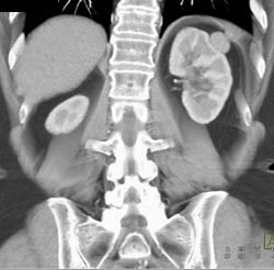 Pancreatic Pseudocyst and Accessory Spleen Near Left Kidney - CTisus CT Scan