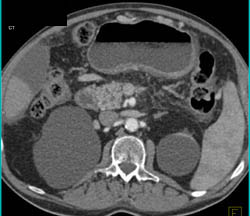 Pancreatic Cancer Encases the SMA/celiac With Collaterals Around the Stomach - CTisus CT Scan