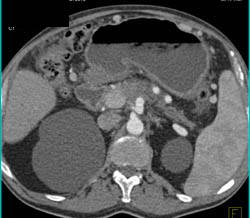 Carcinomatosis Due to Pancreatic Cancer - CTisus CT Scan