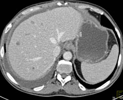 Pancreatic Cancer With Liver Metastases and Carcinomatosis - CTisus CT Scan