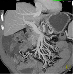 Tumor Encases PV/SMV - CTisus CT Scan