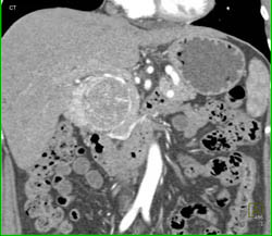 Islet Cell Tumor - CTisus CT Scan