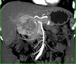 Islet Cell Tumor - CTisus CT Scan