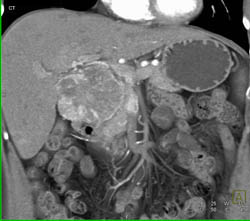 Islet Cell Tumor - CTisus CT Scan