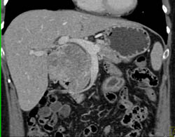 Islet Cell Tumor - CTisus CT Scan