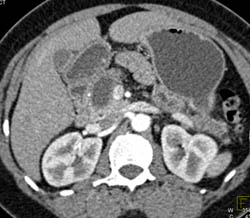 Islet Cell Tumor - CTisus CT Scan