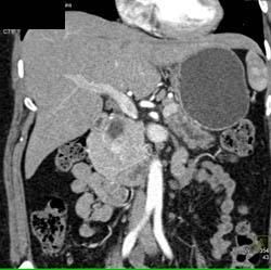 Central Intraductal Papillary Mucinous Neoplasm (IPMN) - CTisus CT Scan