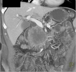 Adenocarcinoma of the Pancreas - CTisus CT Scan