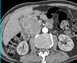 Cystadenoma of the Pancreas With Dilated Pancreatic Duct - CTisus CT Scan