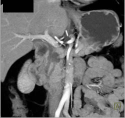 Double Duct Sign With Ampullary Mass - CTisus CT Scan