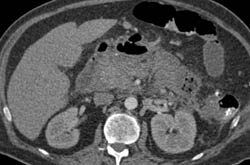 Pancreatic Necrosis and Abscess - CTisus CT Scan