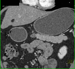 Intraductal Papillary Mucinous Neoplasm (IPMN) - CTisus CT Scan