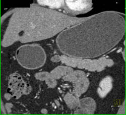 Intraductal Papillary Mucinous Neoplasm (IPMN) - CTisus CT Scan