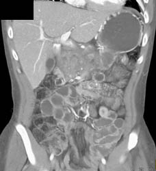 Pancreatic Cancer Encases the PV/SMV - CTisus CT Scan