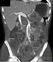 Pancreatic Cancer Encases the PV/SMV - CTisus CT Scan