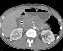 Infiltrating Pancreatic Cancer Encases SMA/celiac and PV/SMV - CTisus CT Scan