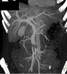 Encased Distal Superior Mesenteric Vein (SMV) - CTisus CT Scan