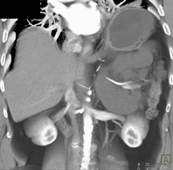 Lymphangioma - CTisus CT Scan