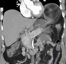 Lymphangioma - CTisus CT Scan