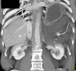 Lymphangioma - CTisus CT Scan