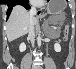 Lymphangioma - CTisus CT Scan